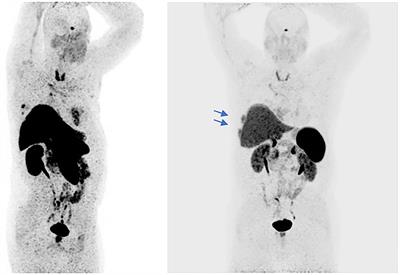 Pembrolizumab in a Patient With Heavily Pre-Treated Squamous Cell Thymic Carcinoma and Cardiac Impairment: A Case Report and Literature Review